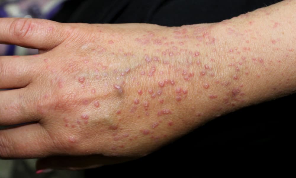Lichen Planus pelle