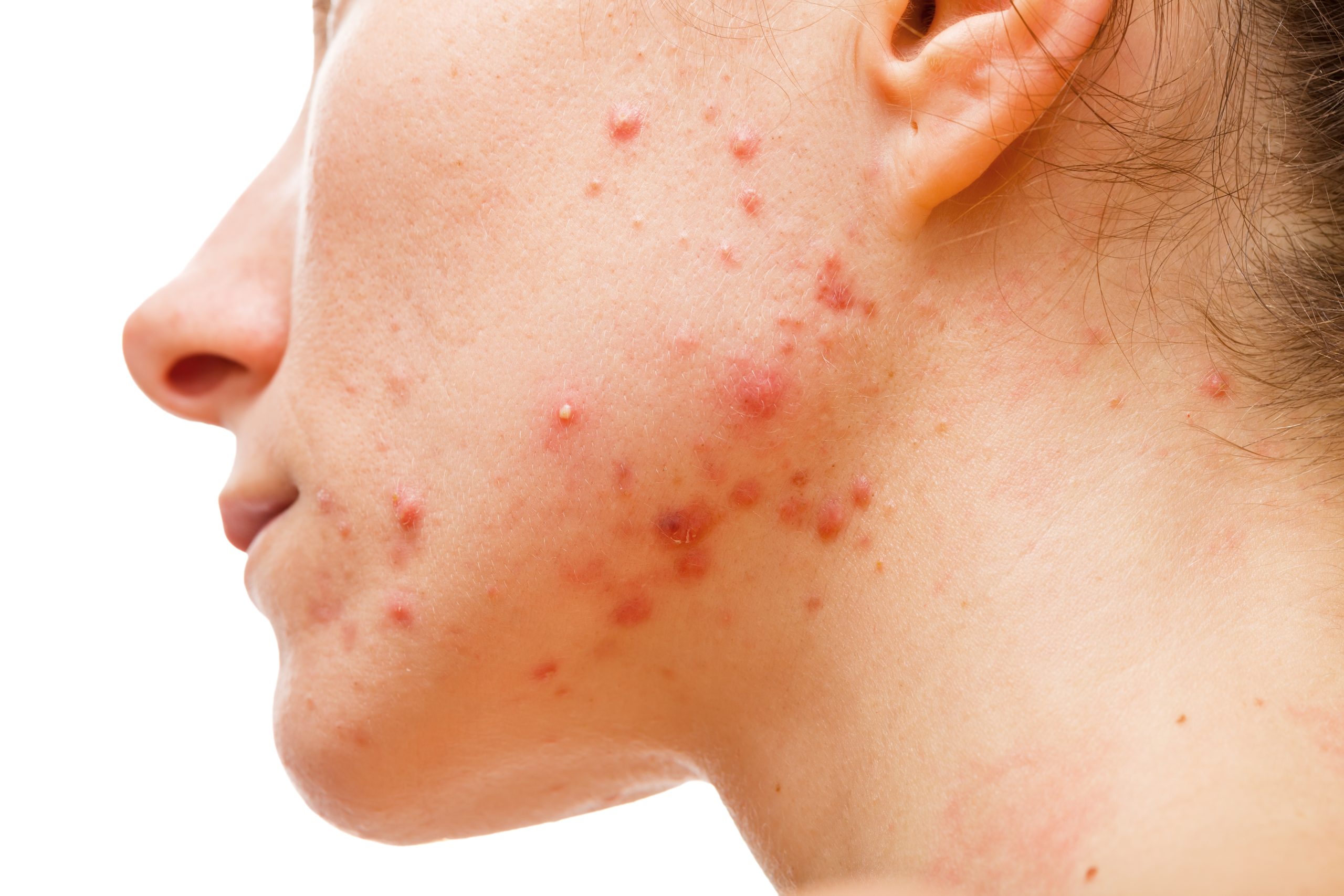 Retinoidi per Acne