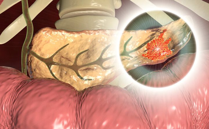 Alimentazione Dopo un Intervento al Pancreas