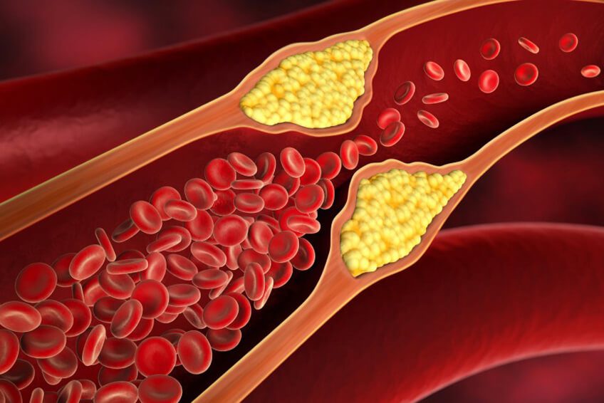 Come inizia l'arteriosclerosi?