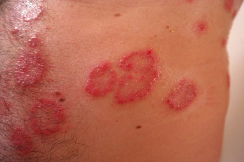 Come sono le macchie di dermatite?