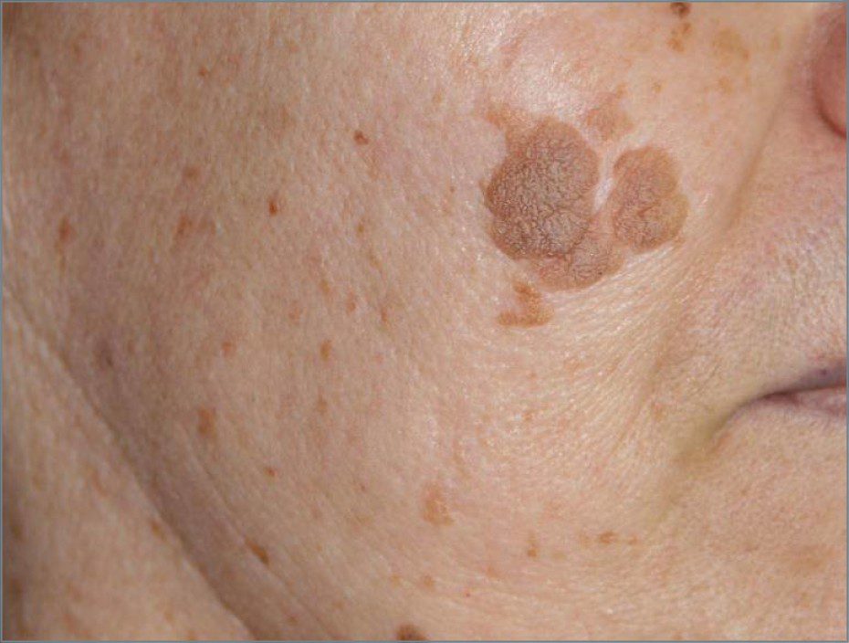 Lesioni Pigmentate della Pelle
