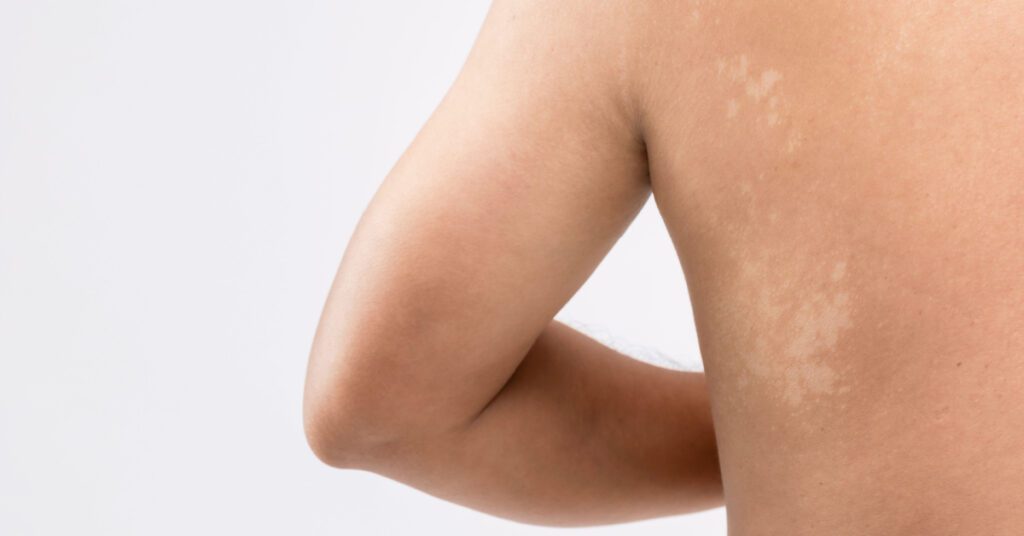 Macchie bianche sulla cute