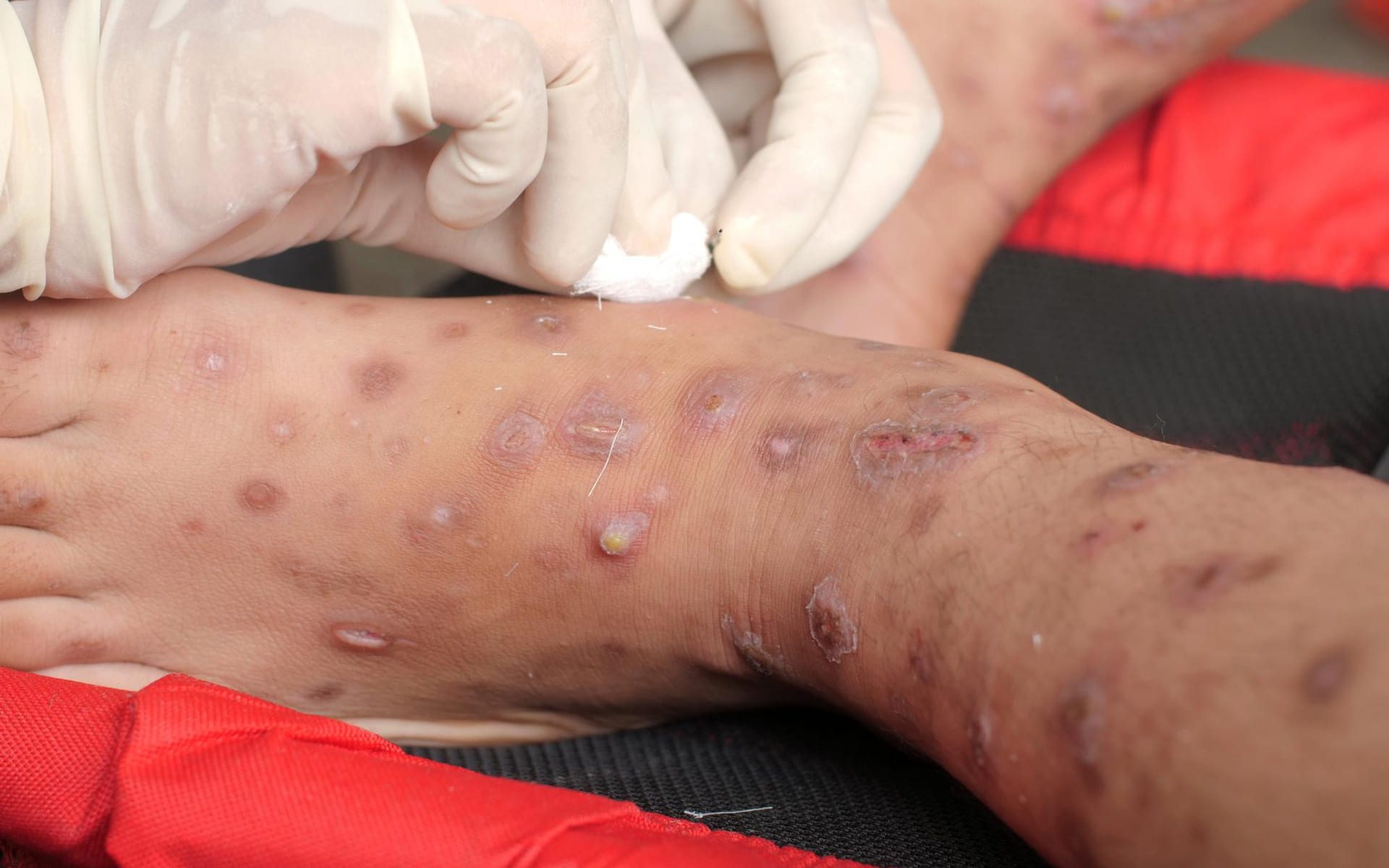 Scabbia: Lesioni della Pelle e Trattamenti Efficaci