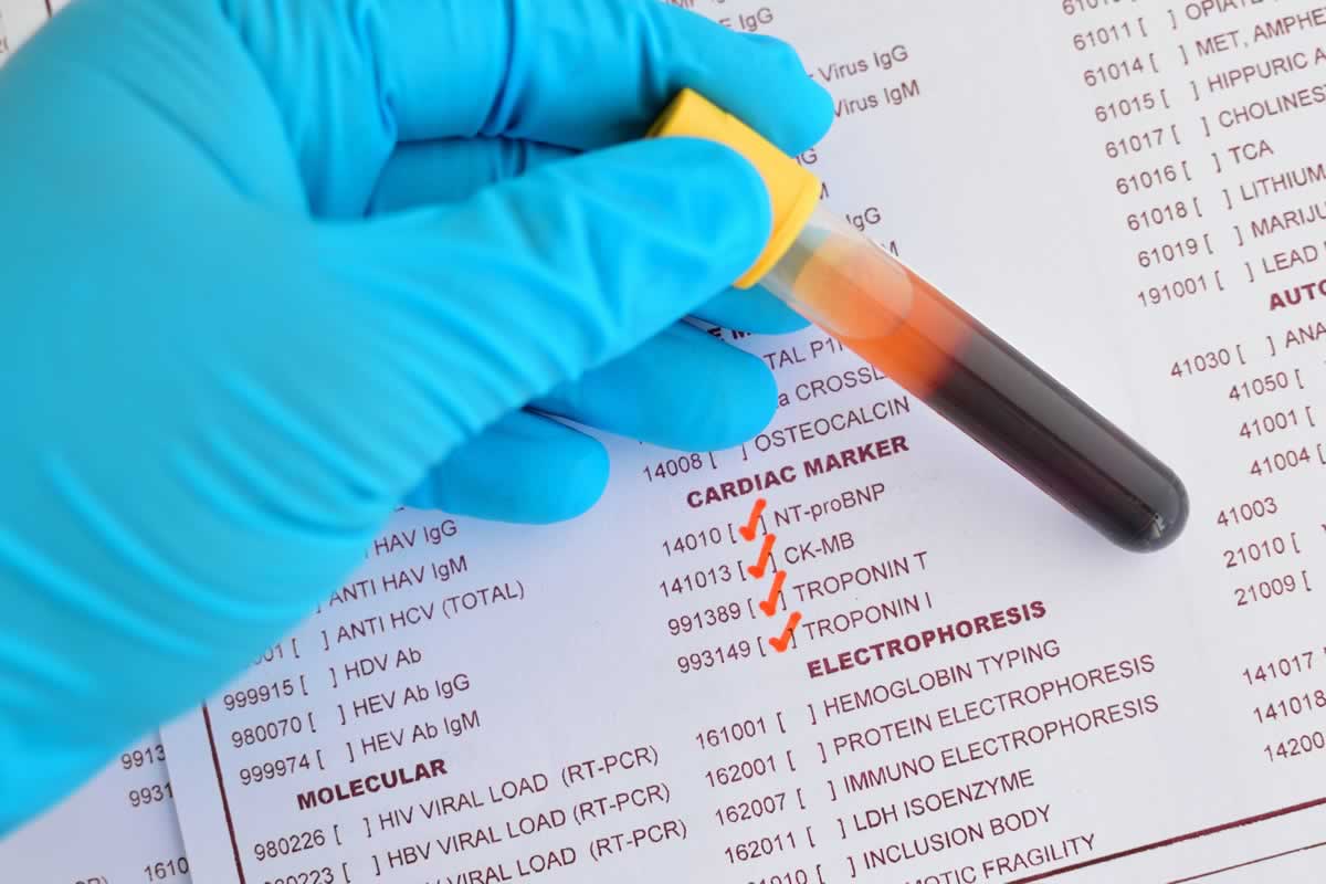 proteina c reattiva alta