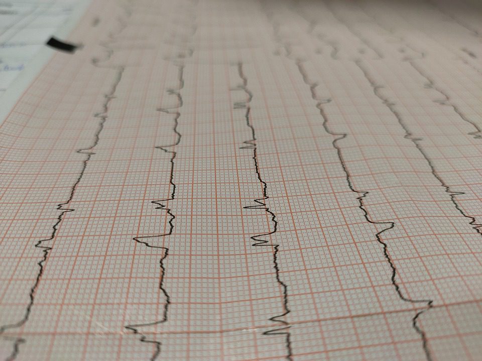 Cardiopatie e Blocco di Branca: Tutto quello che Devi Sapere