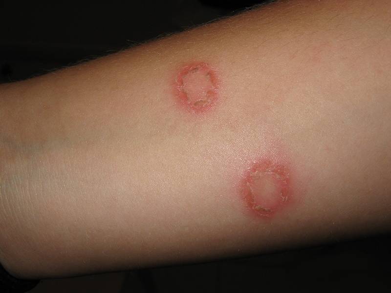 Micosi cutanea
