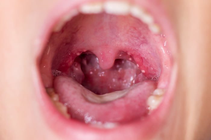 Afte alla faringe: Cause, Sintomi e Trattamenti