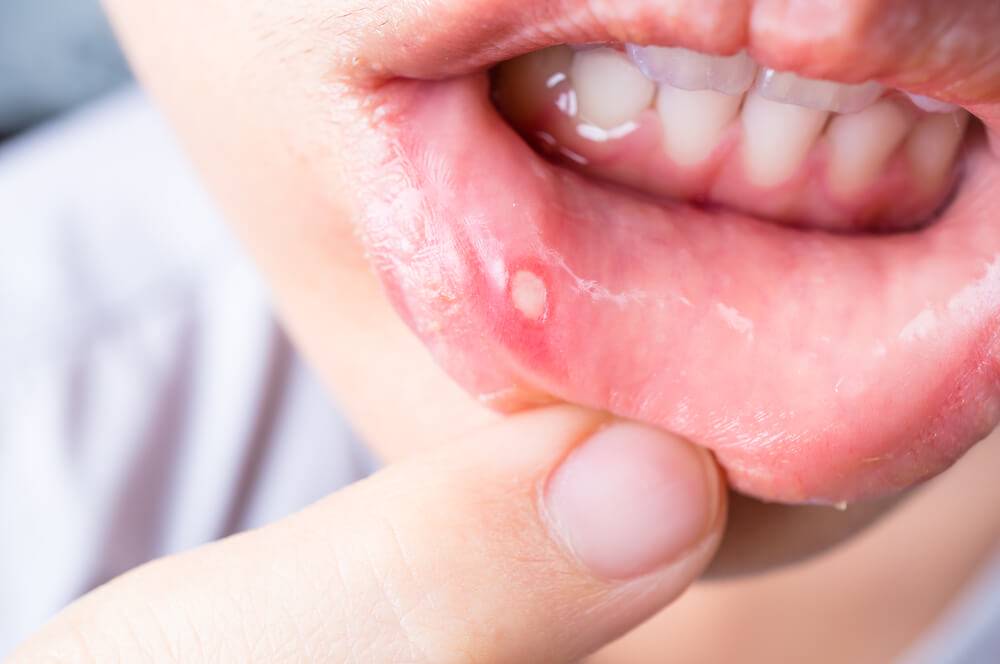 Afte della Bocca: Rimedi Naturali per Alleviare il Fastidio