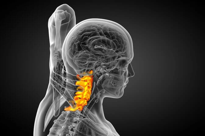 Artrosi Cervicale: Sintomi e Gestione