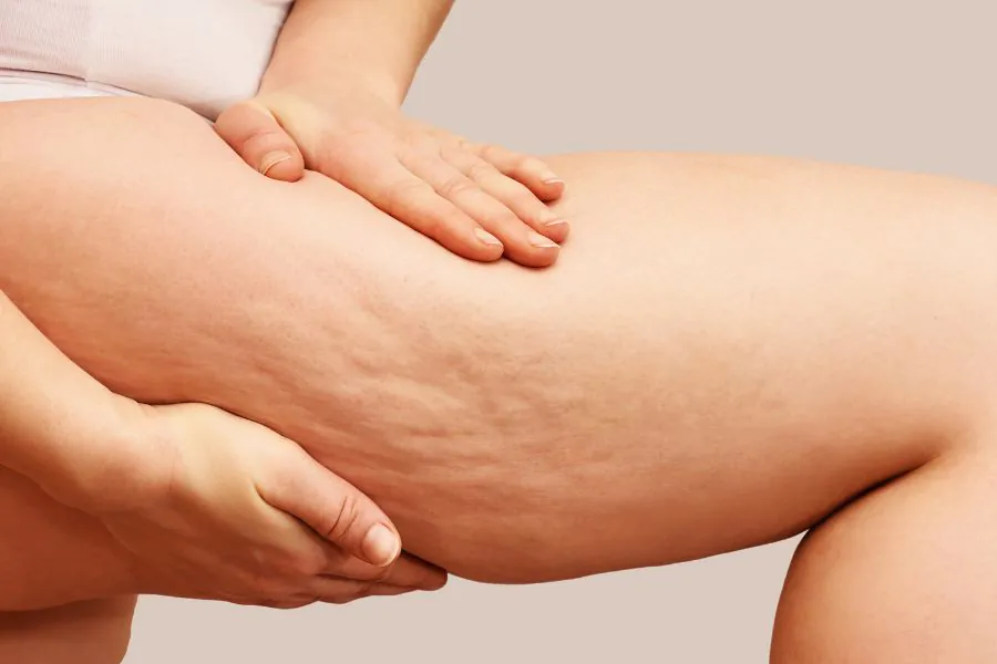 Camminare elimina la cellulite?