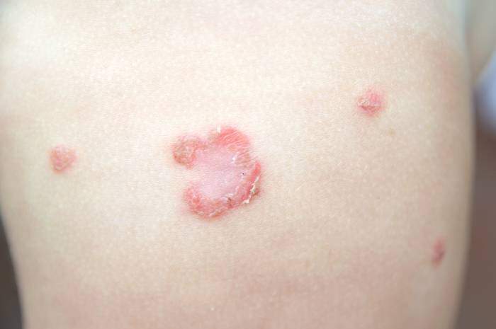 Dermatite batterica: Cause, sintomi e trattamenti