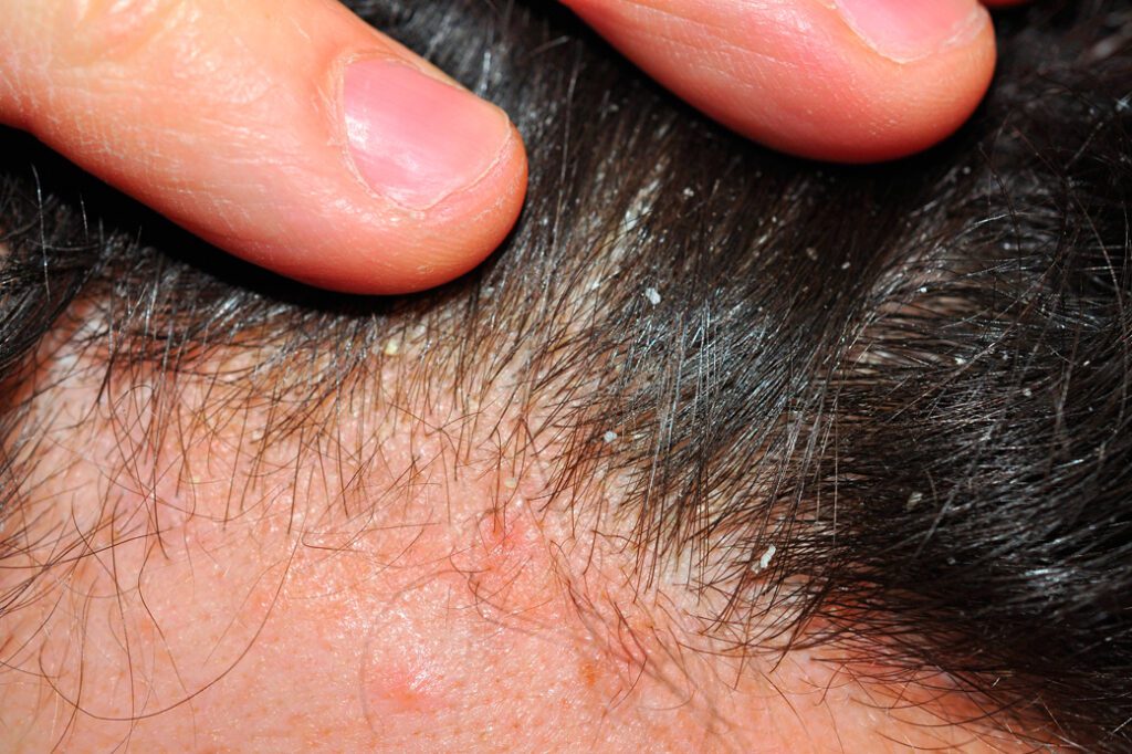 Dermatite del cuoio capelluto: Cause, sintomi e trattamenti