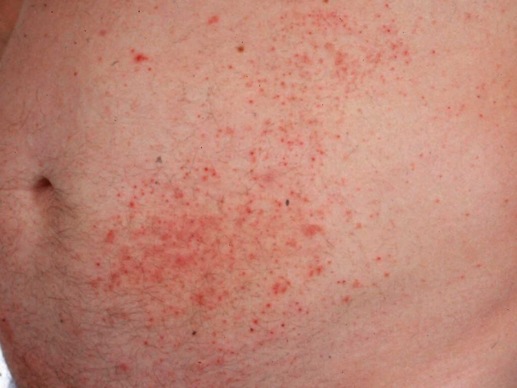 Dermatite erpetiforme: Cause, sintomi e trattamenti