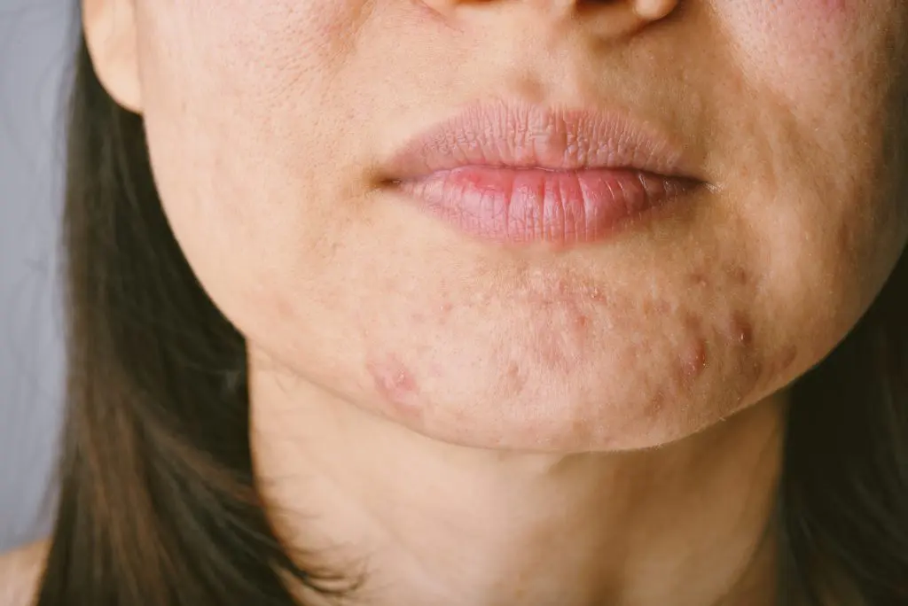 Menopausa e Brufoli: Cause, Sintomi e Rimedi Efficaci