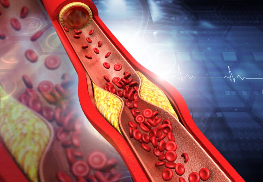 Arteriosclerosi e Memoria: Come l'Arteriosclerosi Influisce sulla Funzione Cognitiva
