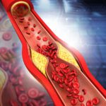 Arteriosclerosi e Memoria: Come l'Arteriosclerosi Influisce sulla Funzione Cognitiva