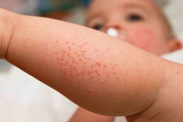 Allergie Cutanee nei Bambini: Cause, Sintomi e Rimedi