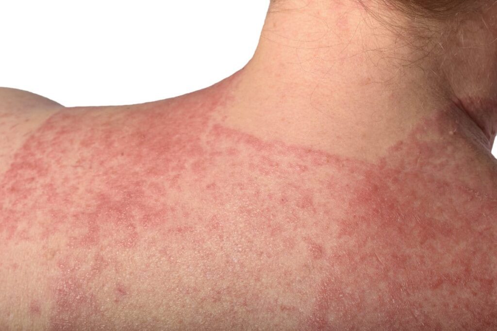 Dermatite da Stasi: Comprendere la Condizione