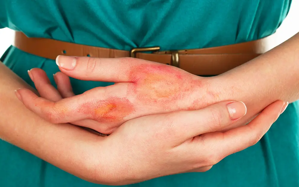 Lesioni della pelle di terzo grado