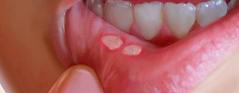 Afte da Streptococco: Cause, Sintomi e Trattamenti