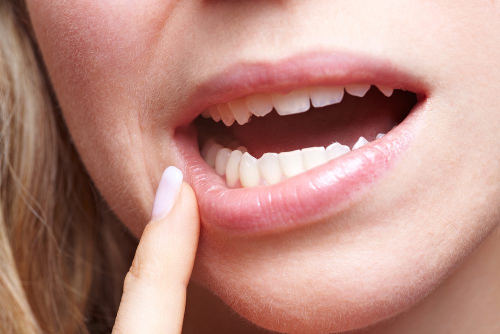Afte dopo estrazione del dente