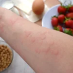 Allergie alla Frutta Secca: Cause, Sintomi e Trattamenti