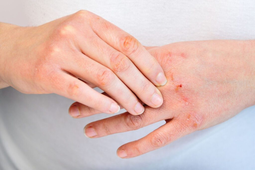 Allergie Gravi: Sintomi, Cause e Trattamenti