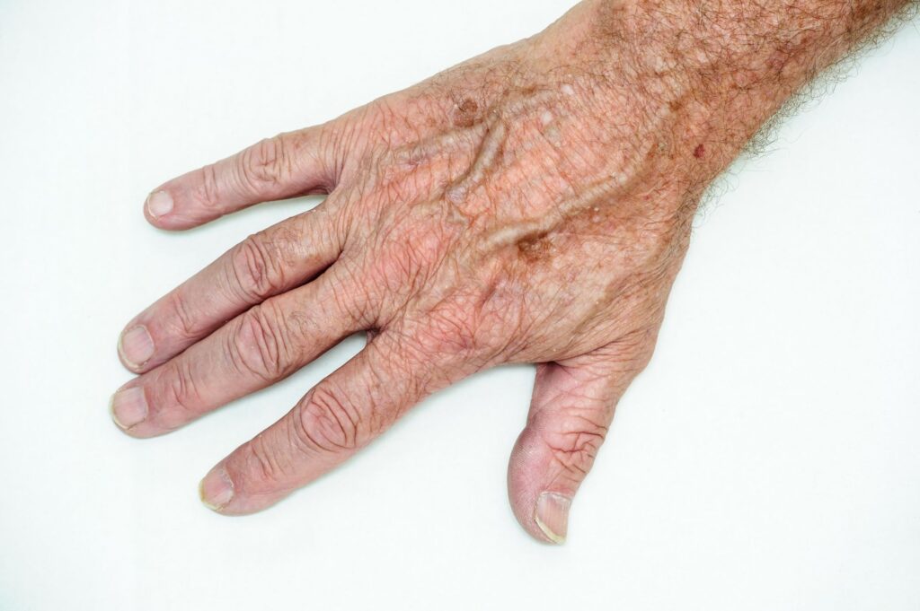 Lesioni cutanee negli anziani: Cause, prevenzione e trattamenti