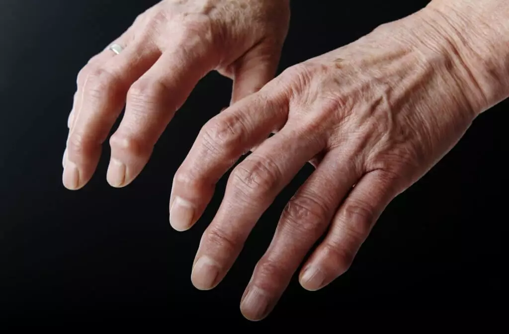 Artrosi alle Mani: Sintomi e Come Riconoscerla