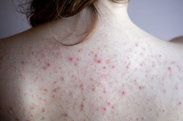 Brufoli sulla Schiena: Cause, Rimedi e Consigli per la Prevenzione
