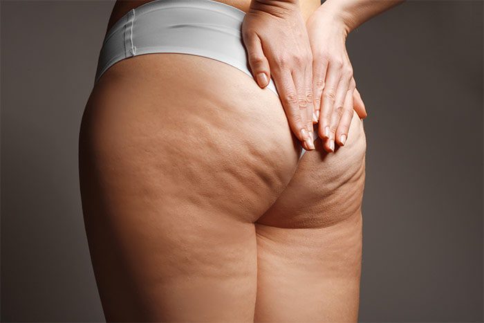 Integratori per la Cellulite: Supporto Naturale per Ridurre la Ritenzione 