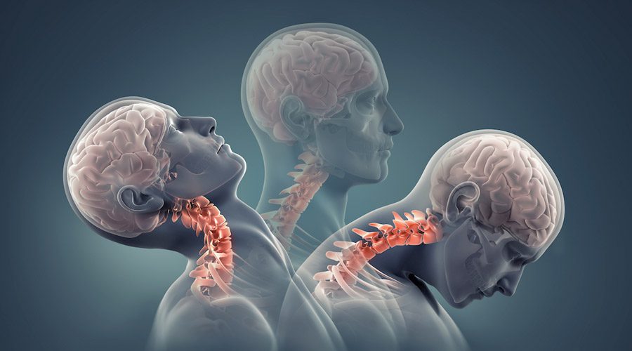 colpo della strega cervicale