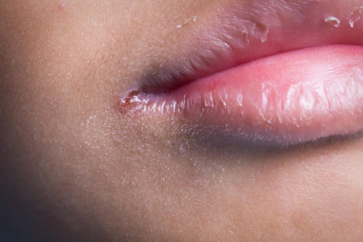 Bocca Spaccata: Cause, Rimedi e Come Prevenire le Labbra Tagliate