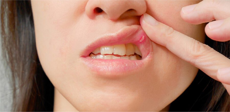 Cura per Afte: Guida ai Rimedi e Trattamenti