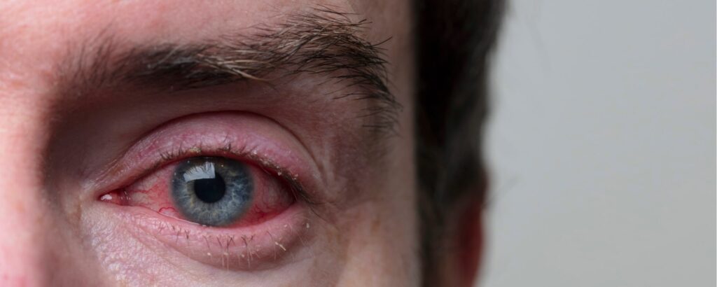 Cura per la Blefarite: Come Gestire l'Infiammazione delle Palpebre