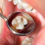 Carie ai Denti: Sintomi, Cause e Trattamenti