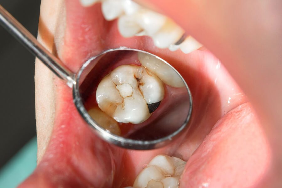 Carie ai Denti: Sintomi, Cause e Trattamenti