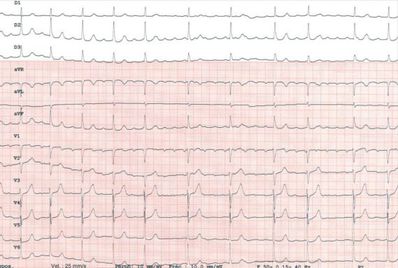 Tachicardia atriale: diagnosi tramite ECG e trattamento
