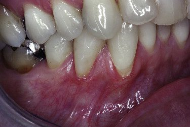 Enfisema Dentale: Cos’è, Cause, Sintomi e Trattamenti
