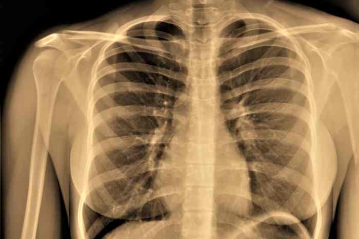 Enfisema Facciale: Cause, Sintomi e Trattamenti