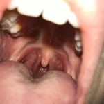 Gola Biancastra: Cause e Possibili Rimedi
