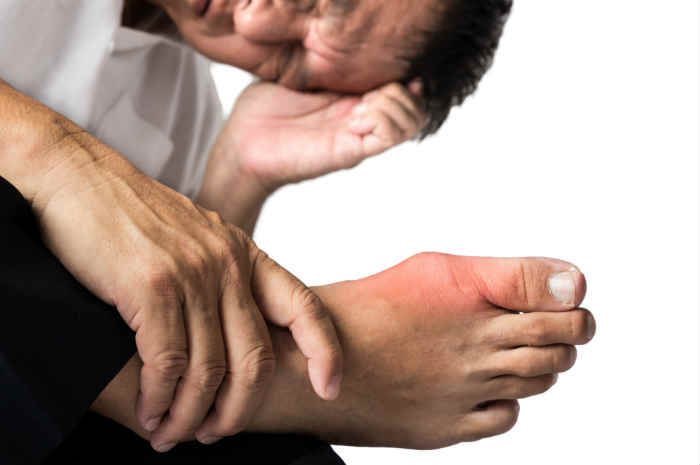 Camminare con la Gotta: Consigli, Benefici e Precauzioni