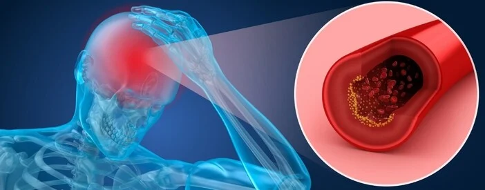 Ictus Cerebrale: Sintomi Iniziali e Cosa Fare
