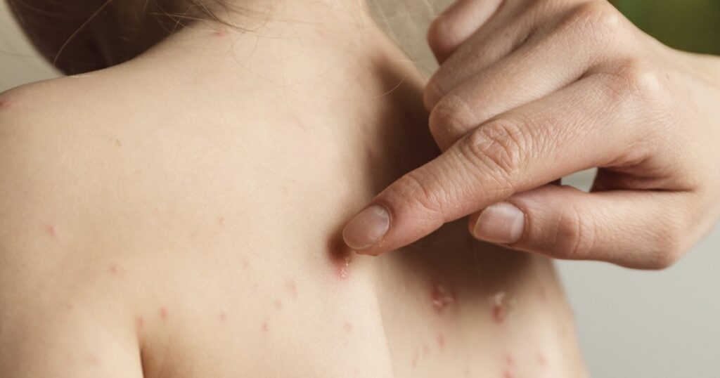 Lesioni della pelle vescicolari