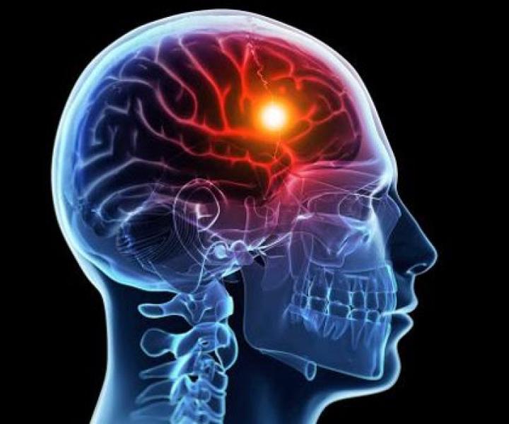 Infarto Cerebrale: Sintomi, Cause e Trattamenti
