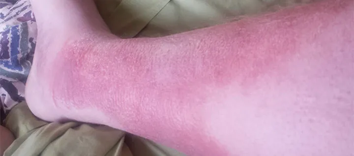 Irritazione alla gamba: Cause e rimedi