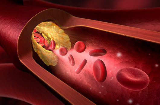 Ischemia degli Arti Inferiori: Cause, Sintomi e Terapia