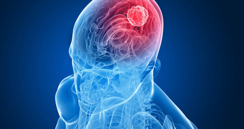 Ischemia e Aneurisma: Differenze, Cause e Trattamenti