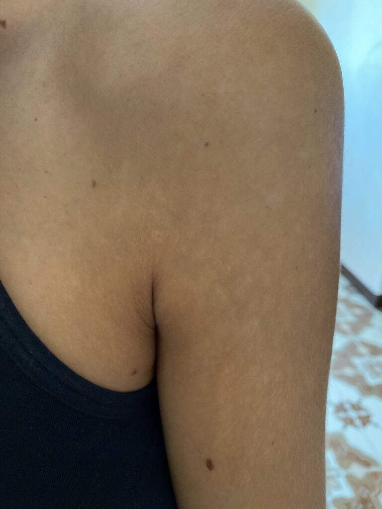 Lesioni cutanee bianche: cause, sintomi e trattamenti